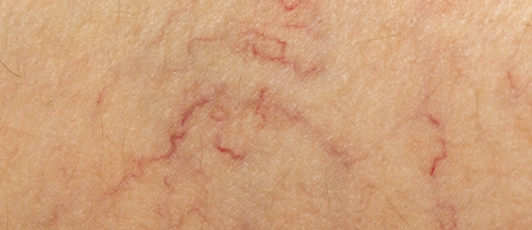 Das Bild zeigt einen Hautausschnitt mit ein paar geplatzten Äderchen, wie es typisch bei der Hauterkrankung Rosazea ist.