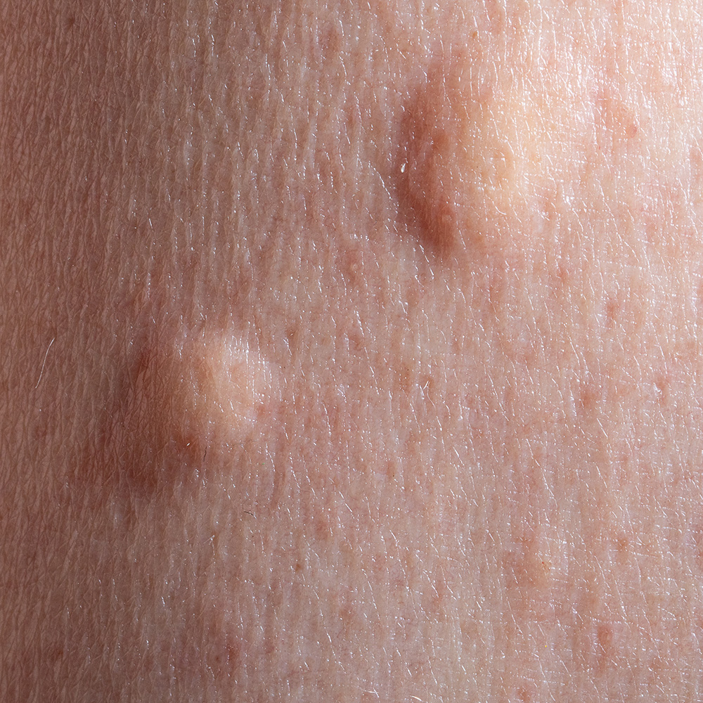 Das Bild zeigt Quaddeln auf der Haut, die sich durch Hitze bilden können. 